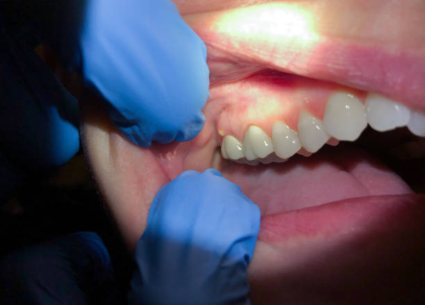 Best Emergency Dental Care for Broken or Chipped Teeth in Charlestown, IN