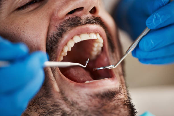 Best Emergency Wisdom Teeth Removal in Charlestown, IN
